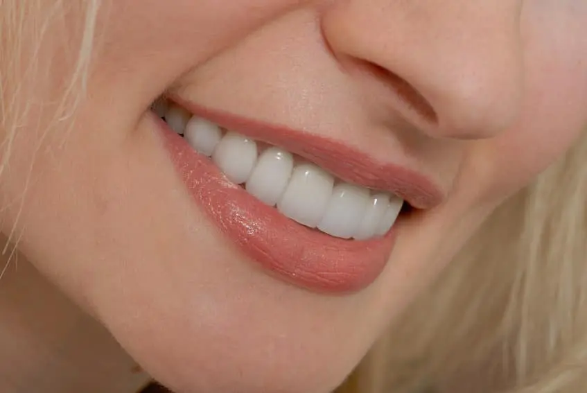 dental veneers