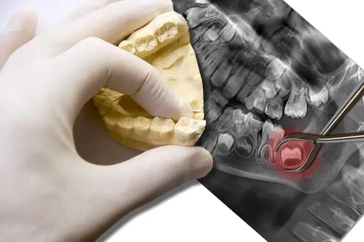 wisdom teeth wisdom teeth