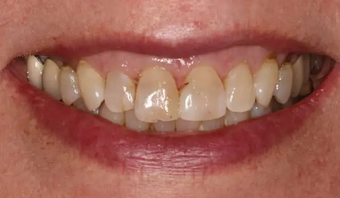 Before Close up of smile before cosmetic dentistry.