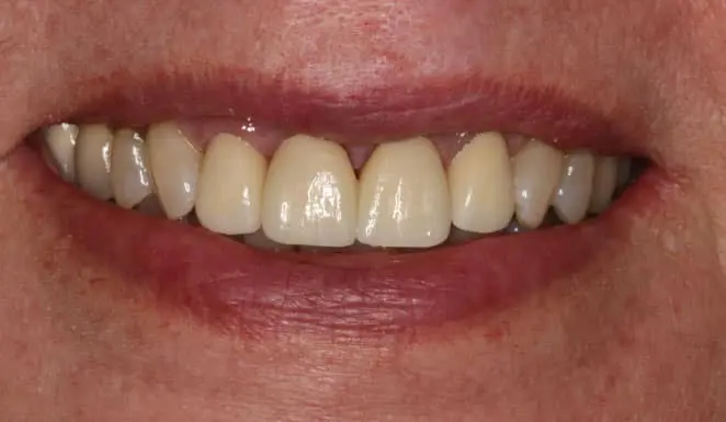 After Close up of smile after cosmetic dentistry.