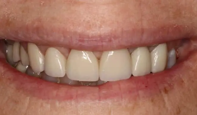 After Close up of smile after cosmetic dentistry.