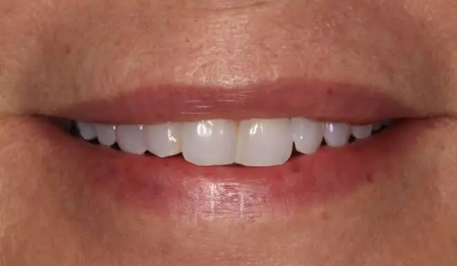 Before Porcelain veneers and crowns on 8 front teeth