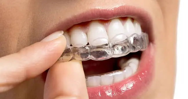 Closeup of Affordable Braces near Harrison Township MI