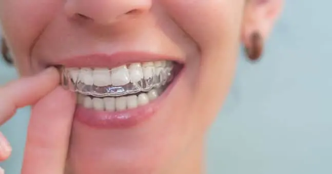 Closeup of Clear Braces near New Haven MI