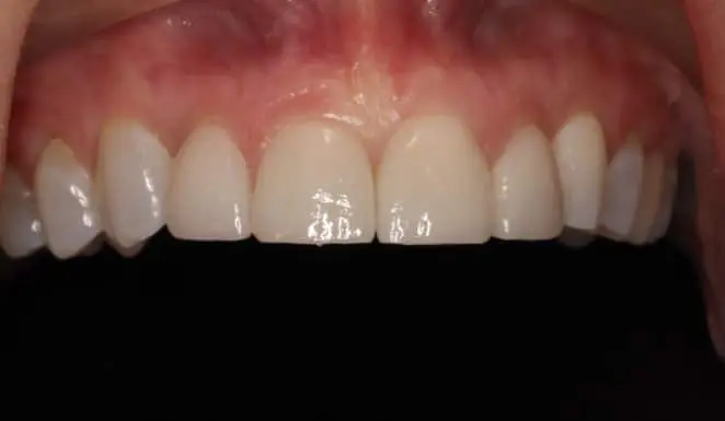 After After Porcelain veneers on 4 front teeth