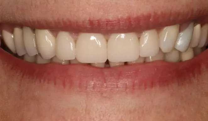 After After Porcelain veneers on 4 front teeth