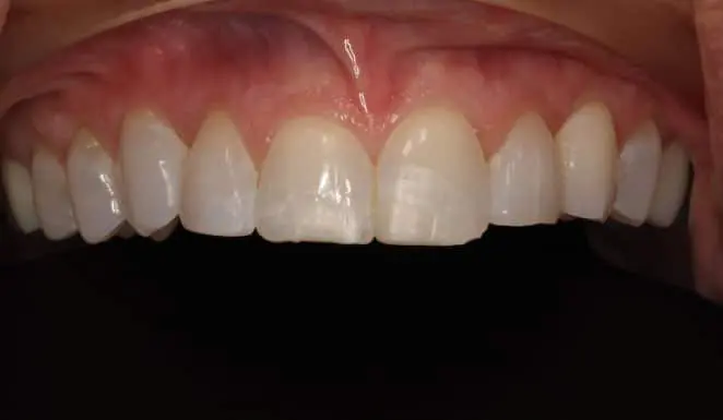 Before BeforePorcelain veneers on 4 front teeth