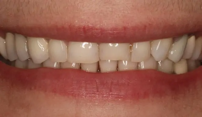 Before Before Porcelain veneers on 4 front teeth