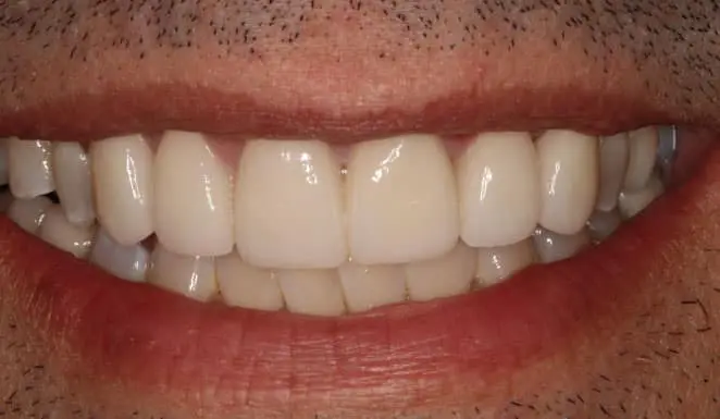 After After Porcelain veneers on 6 front teeth
