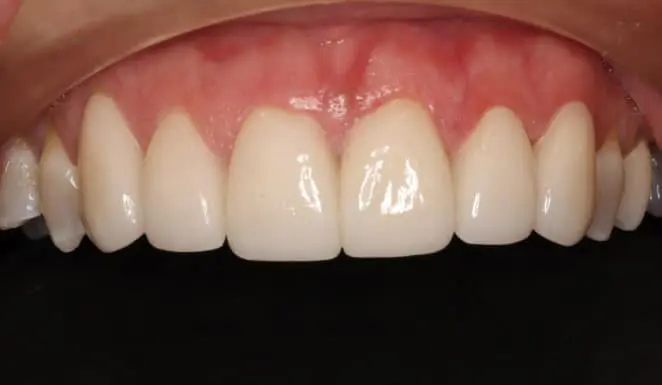 After After Porcelain veneers on 6 front teeth