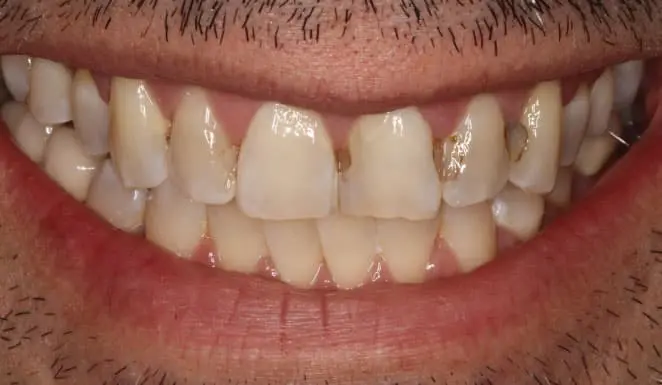 Before Before Porcelain veneers on 6 front teeth