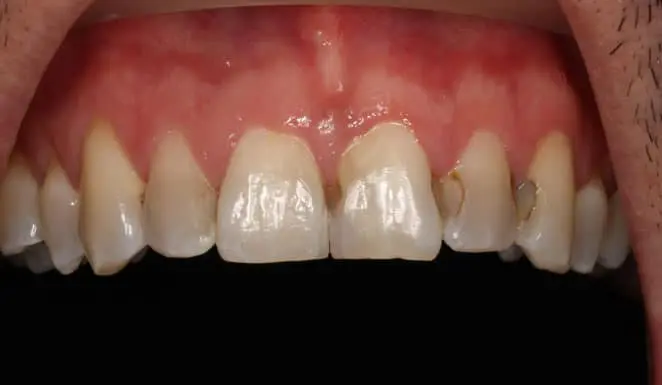 Before Before Porcelain veneers on 6 front teeth