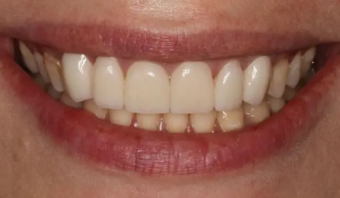 After After Porcelain veneers on 6 front teeth