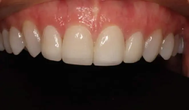 After After 4 Porcelain Veneers