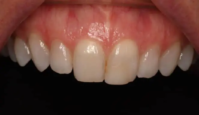 Before Before 4 Porcelain Veneers