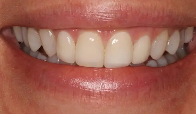 After After 4 Porcelain Veneers