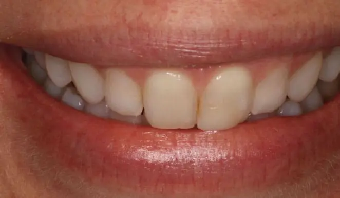 Before Before 4 Porcelain Veneers