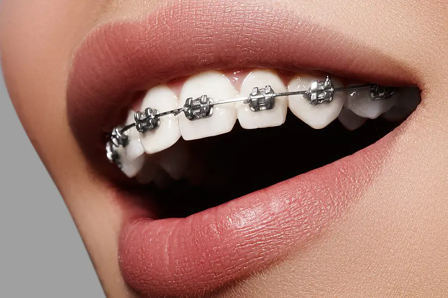 Beautiful White Teeth With Braces. Dental Care Photo. Woman Smil