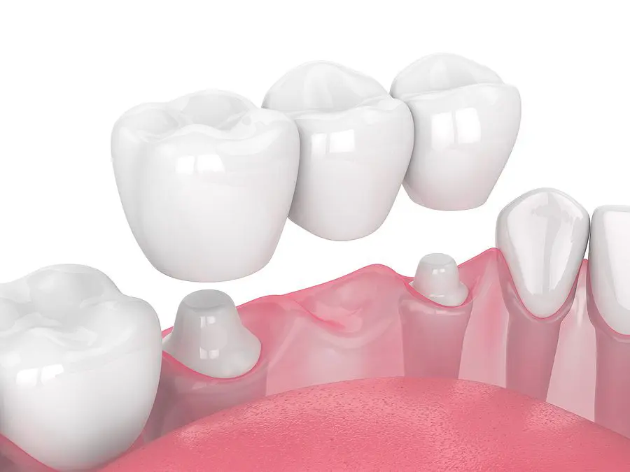 3D Render Of Jaw With Dental Bridge