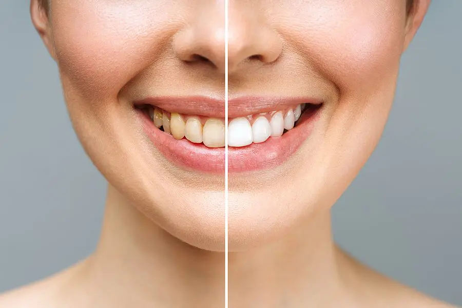 Woman Teeth Before And After Whitening. Over White Background. D