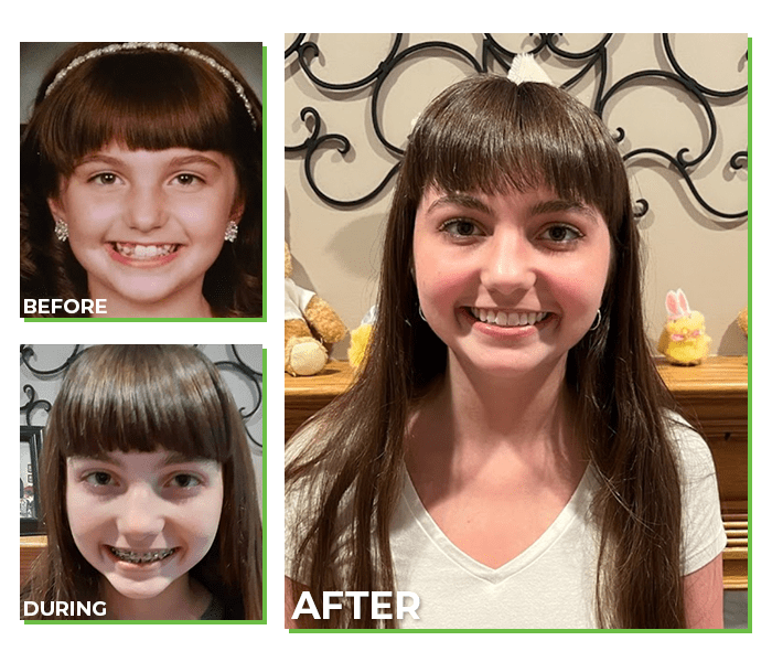 Orthodontics-Patient-Before-During-After