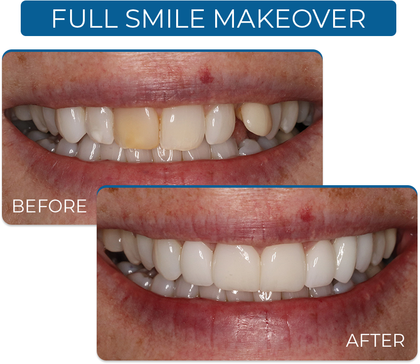 Graham Lois Before/After