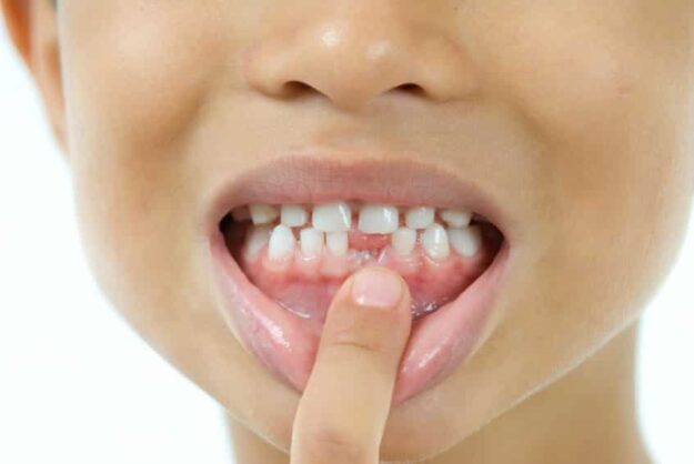 Loose tooth Loose tooth