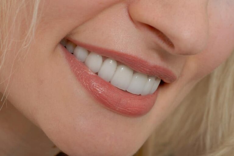 dental veneers