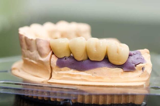 porcelain crowns porcelain crowns