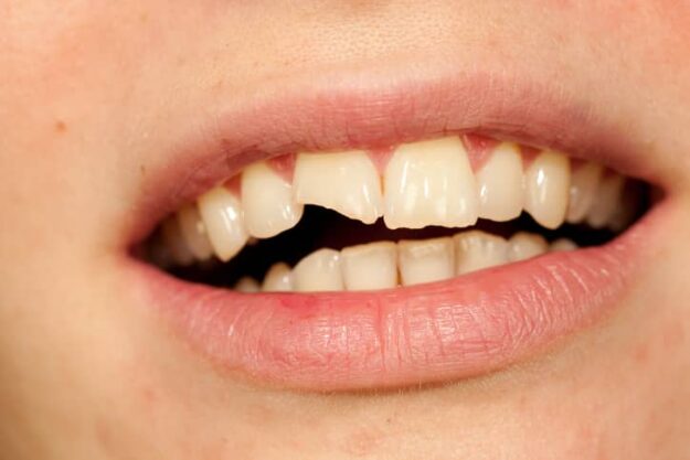 chipped tooth chipped tooth
