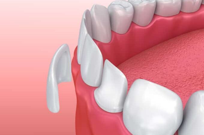 dental veneers