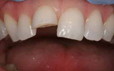 Before Before