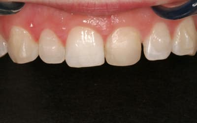 Before Before