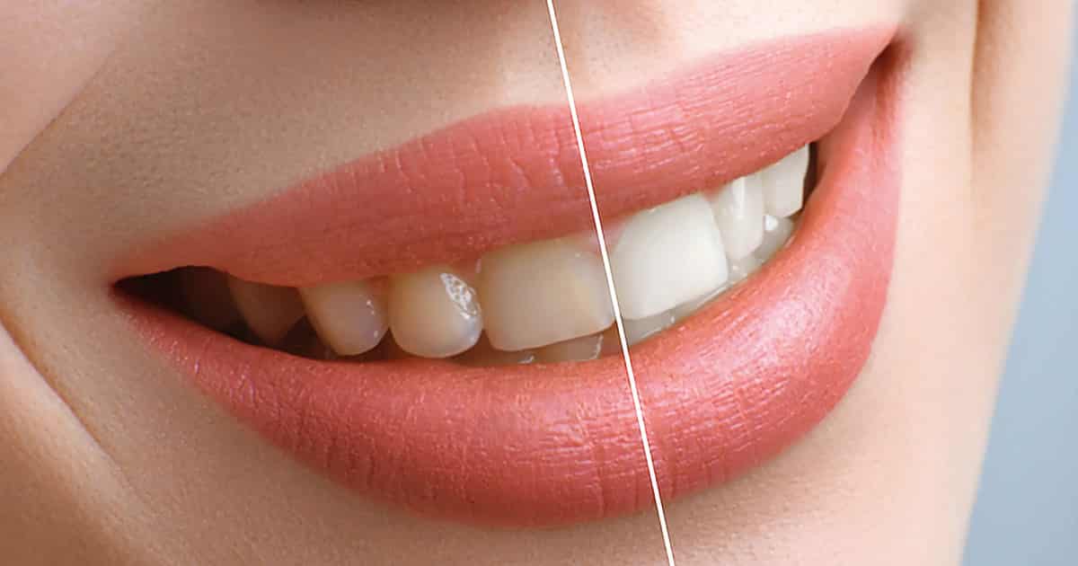 Teeth Whitening - Chesterfield, MI