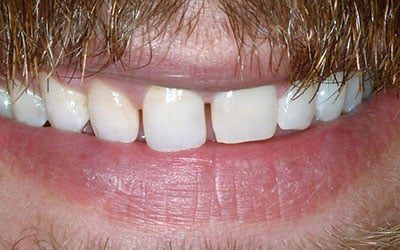 Before Cosmetic Dentistry