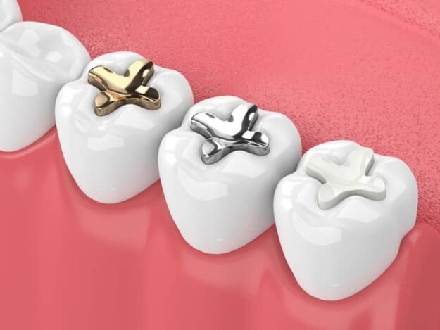 care-for-dental-filling