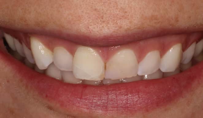 Close up of smile before cosmetic dentistry.