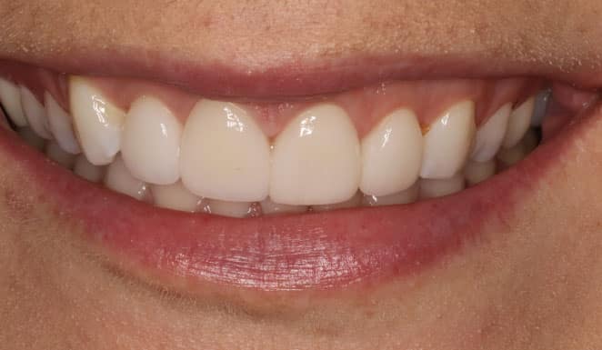 Close up of smile after cosmetic dentistry.
