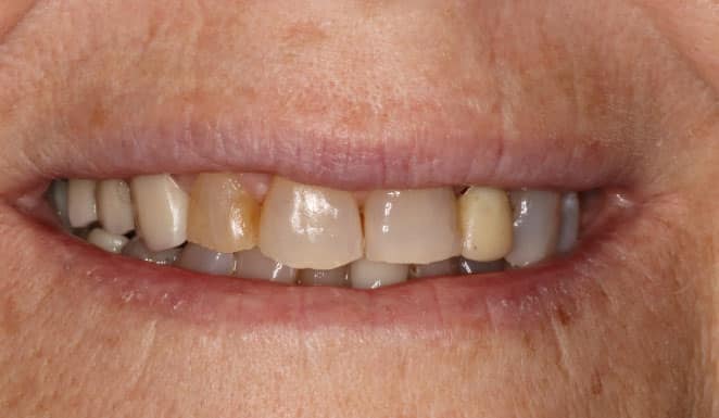 Close up of smile before cosmetic dentistry.