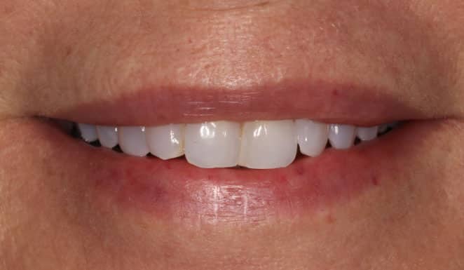 Porcelain veneers and crowns on 8 front teeth