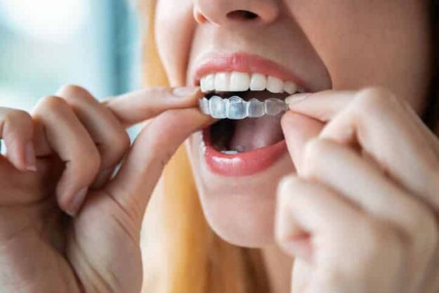 do-invisible-braces-work