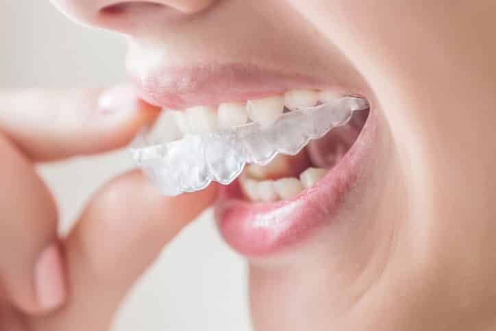 What Invisalign Can and Can't Do