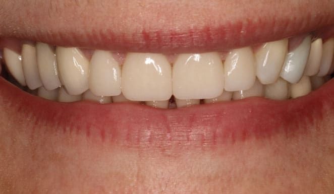 After Porcelain veneers on 4 front teeth