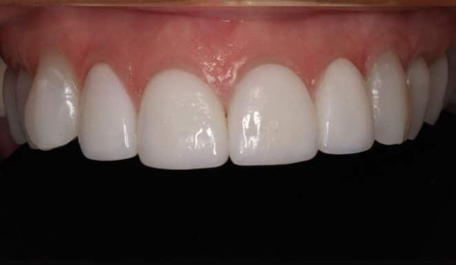 After Porcelain veneers on 4 front teeth