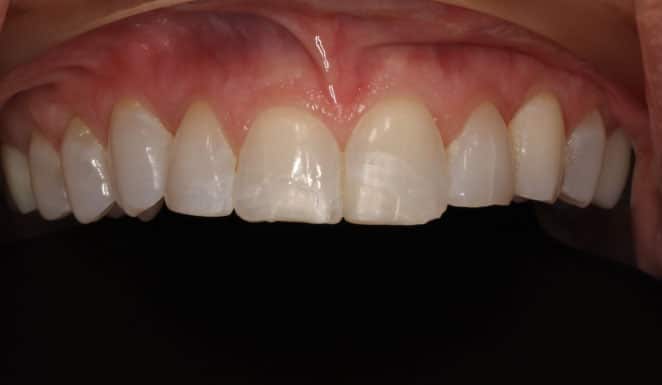BeforePorcelain veneers on 4 front teeth