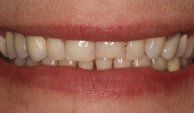 Before Porcelain veneers on 4 front teeth