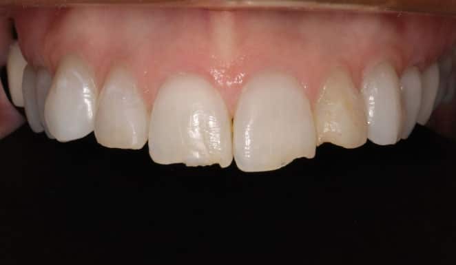 Before Porcelain veneers on 4 front teeth