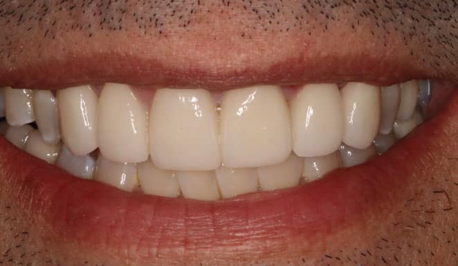 After Porcelain veneers on 6 front teeth