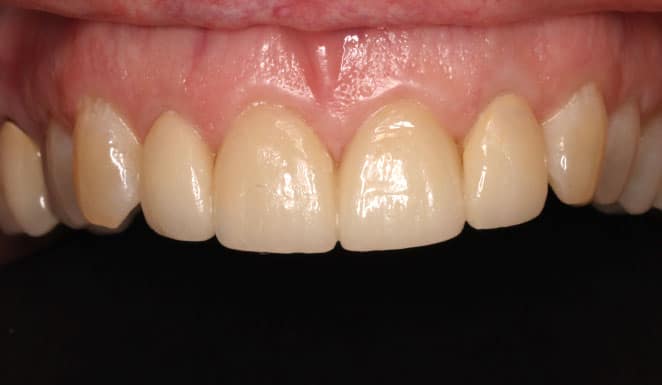 Porcelain veneers on 4 front teeth