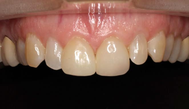 Porcelain veneers on 4 front teeth